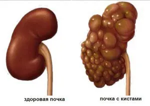як лікувати кісту в нирці