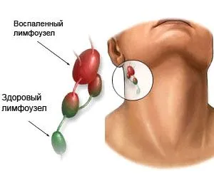як лікувати лімфовузли в домашніх умовах
