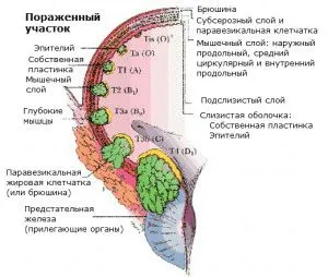 рак сечового міхура