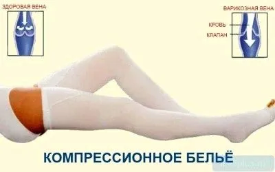 вилікувати варикоз назавжди