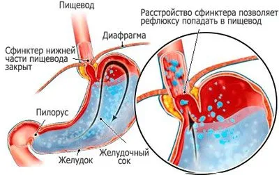як лікувати закид жовчі в стравохід