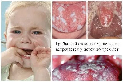Стоматит: причини, симптоми, лікування і профілактика як лікувати травматичний стоматит