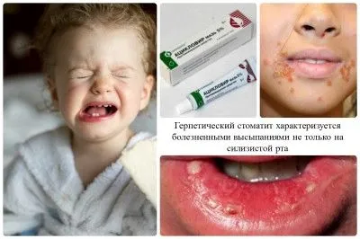 як лікувати стоматит ацикловиром