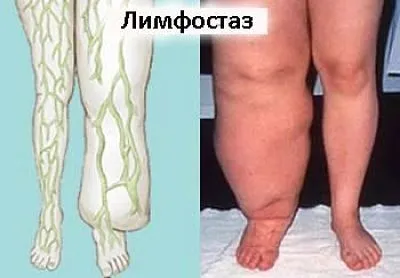 гомеопатія в лікуванні лімфостазу