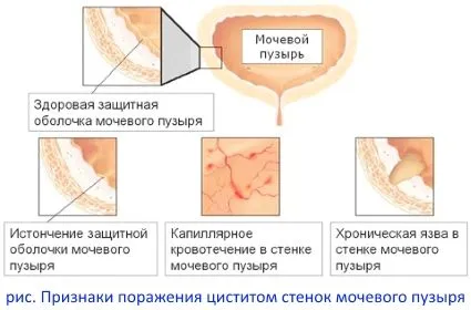як лікувати легкий цистит