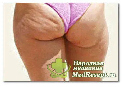 як лікувати целюліт на ногах