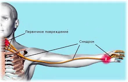 як лікувати невралгію під лопаткою