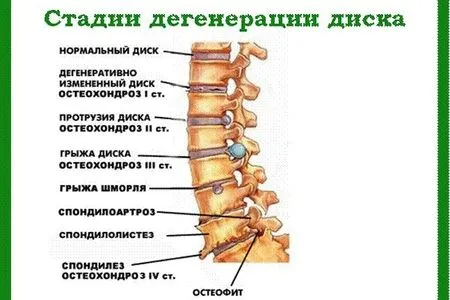 шийний остеохондроз симптоми лікування домашні рецепти лікування грудної поперековий упрадненія