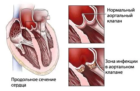 як лікувати ревматизм суглобів