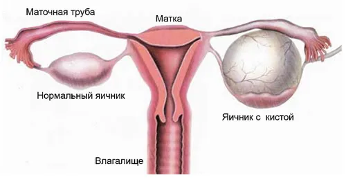 як лікувати кісту жовтого тіла під час вагітності