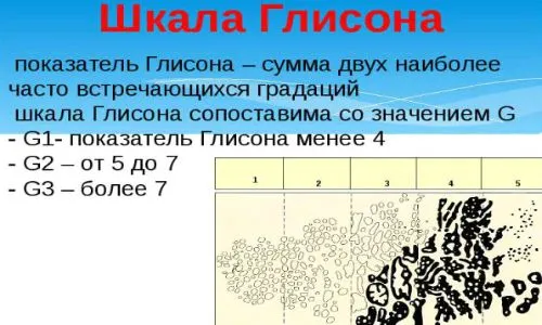 як вилікувати рак 1 ступеня