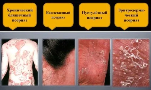 Як вилікувати псоріаз на очах? як вилікувати псоріаз на обличчі