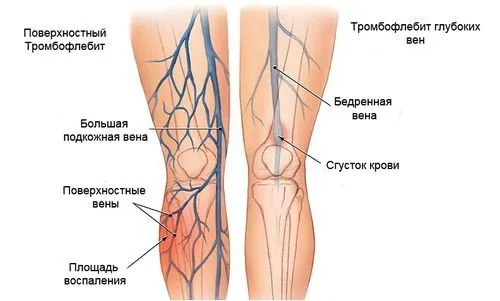 Варикоз і тромбофлебіт: в чому різниця? як лікувати варикоз і тромбофлебіт