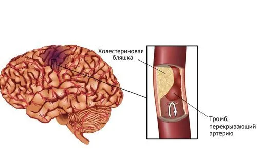 наслідки після інсульту