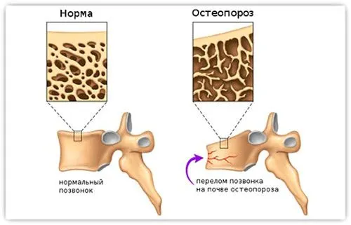 ніж лікувати остеопороз якими ліками