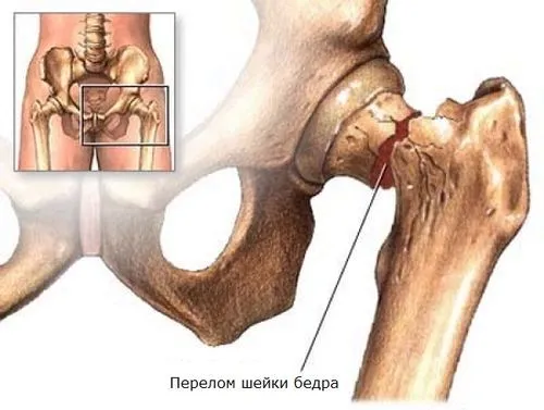 Як довго лікувати остеопороз рух