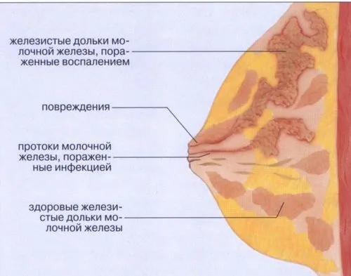 як лікують лактостаз