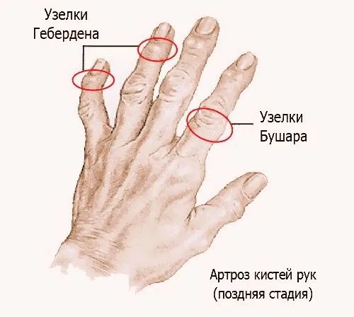 Остеоартроз кистей рук як лікувати суглоби кистей рук