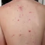 Лікування депресії травами як лікувати депресію травами