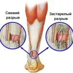 як лікувати розтягнення гомілки