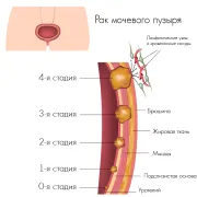 як лікувати рак сечового міхура