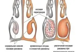 лікування риніту