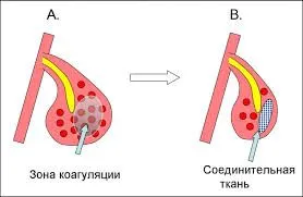 Медикаментозний риніт як лікувати медикаментозний риніт