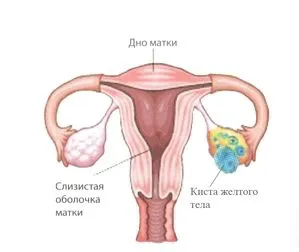 чи можна лікувати кісту яєчника антибіотиками