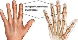 як лікувати артроз суглобів пальців рук