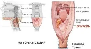 Рак горла: симптоми, ознаки та стадії як лікувати рак гортані 4 стадії
