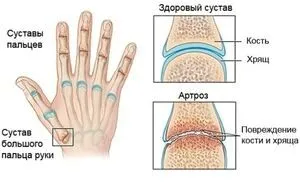 артроз інших суглобів