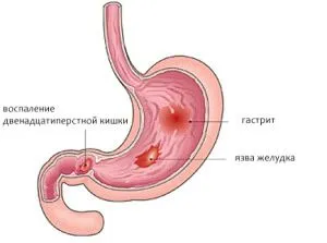 виразка шлунка