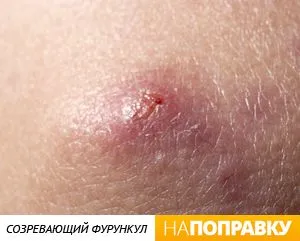 фурункул причини