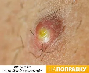 фурункул причини