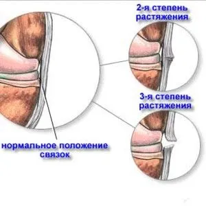 як лікувати розтягнення м'язів в домашніх умовах