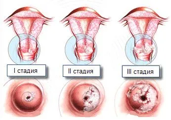 3 Стадія раку шийки матки як лікувати рак шийки матки 3 ступеня