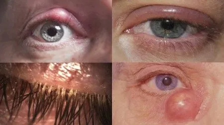 як лікувати хронічний блефарит