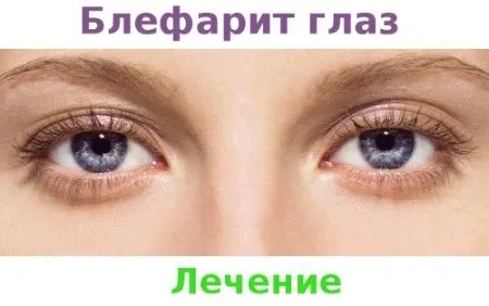 як лікувати хронічний блефарит