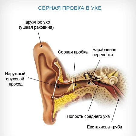 як лікувати вуха від сірки