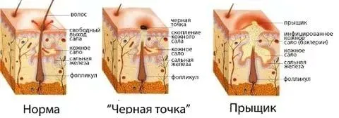як лікувати прищі на щоках в домашніх умовах
