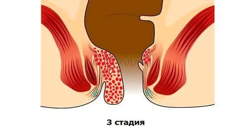 лікувати геморой 3 стадії
