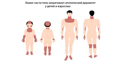 лікувати алергію гомеопатією