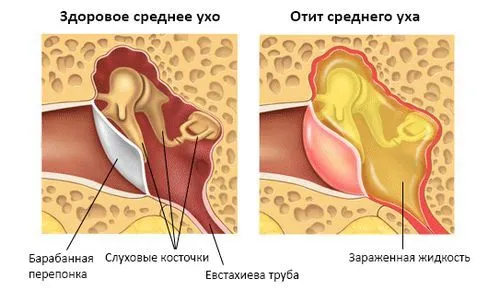 Середній отит як лікувати інфекційний отит