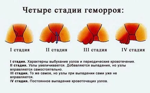 як вилікувати геморой запеченим цибулею