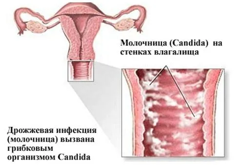 чи можна лікувати трихомоніаз під час місячних