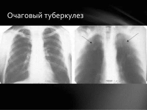 як лікувати хворобу туберкульоз