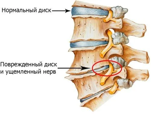як лікувати ранній остеохондроз