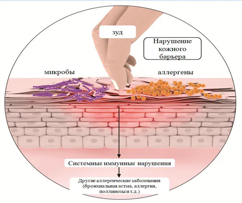 лікувати алергію гомеопатією