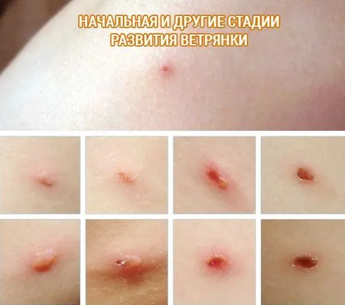 як лікувати вітрянку на ранній стадії