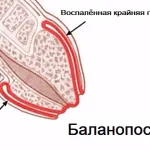 як лікувати баланопостит народними засобами